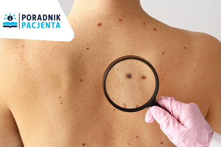 Na zdjęciu widnieją plecy osoby dorosłej ze zmianami skórnymi, oraz dłoń trzymająca lupę w celu powiększenia obrazu zmiany skórnej. 
