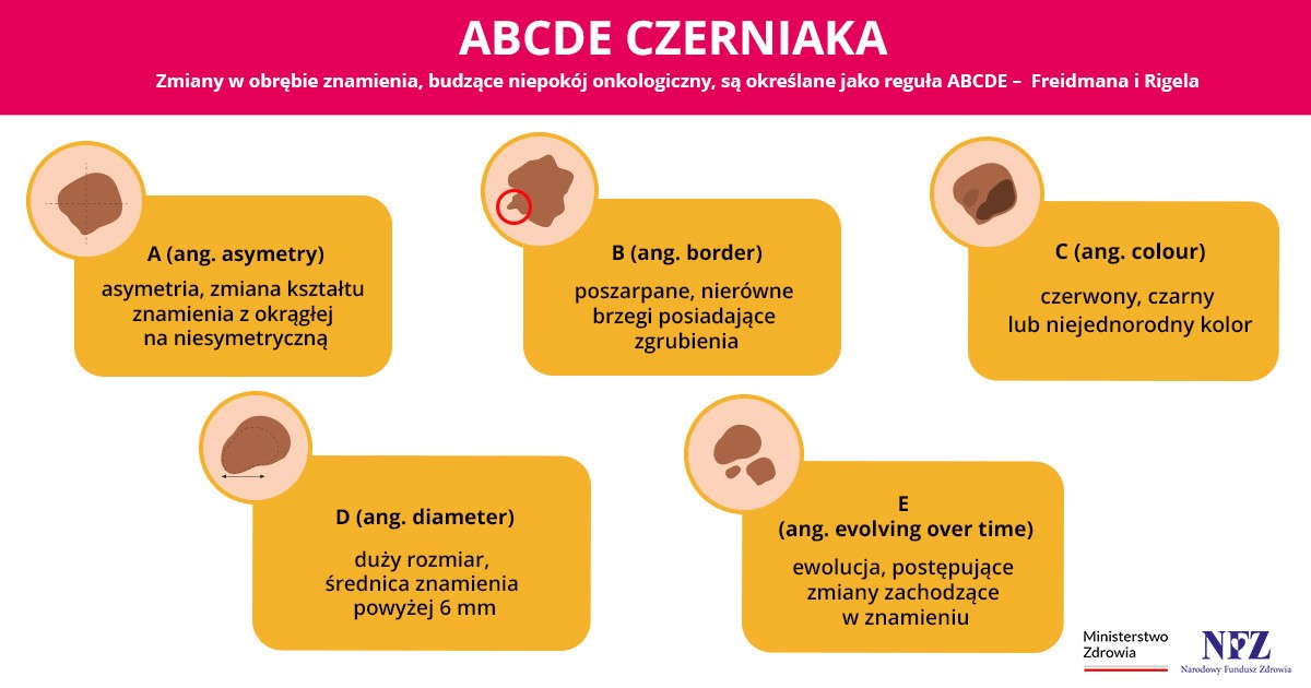 Kryterium ABCDE czerniaka